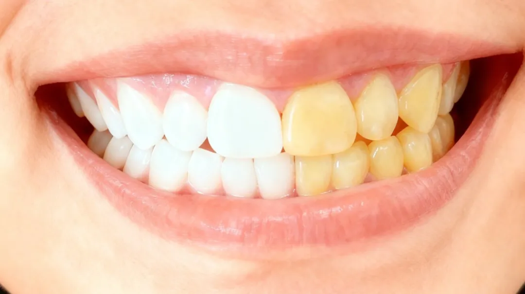 【口腔科普】牙齿美白完整攻略：从此告别大黄牙！