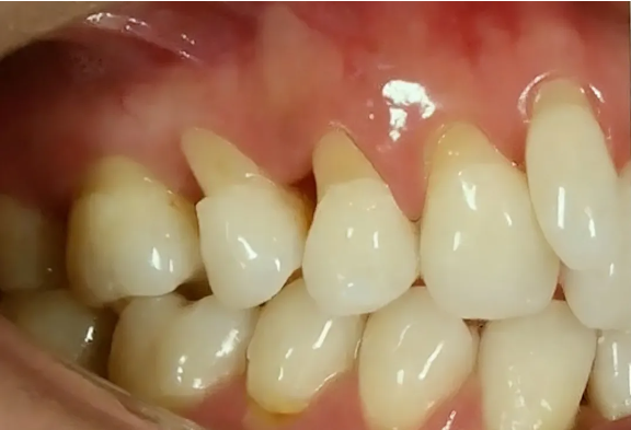 【口腔科普】警惕刷牙刷出的 “颈部缺口”，放任不管，最终只能拔牙收场！