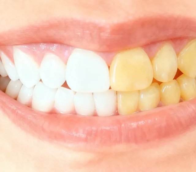 【口腔科普】牙齿美白完整攻略：从此告别大黄牙！