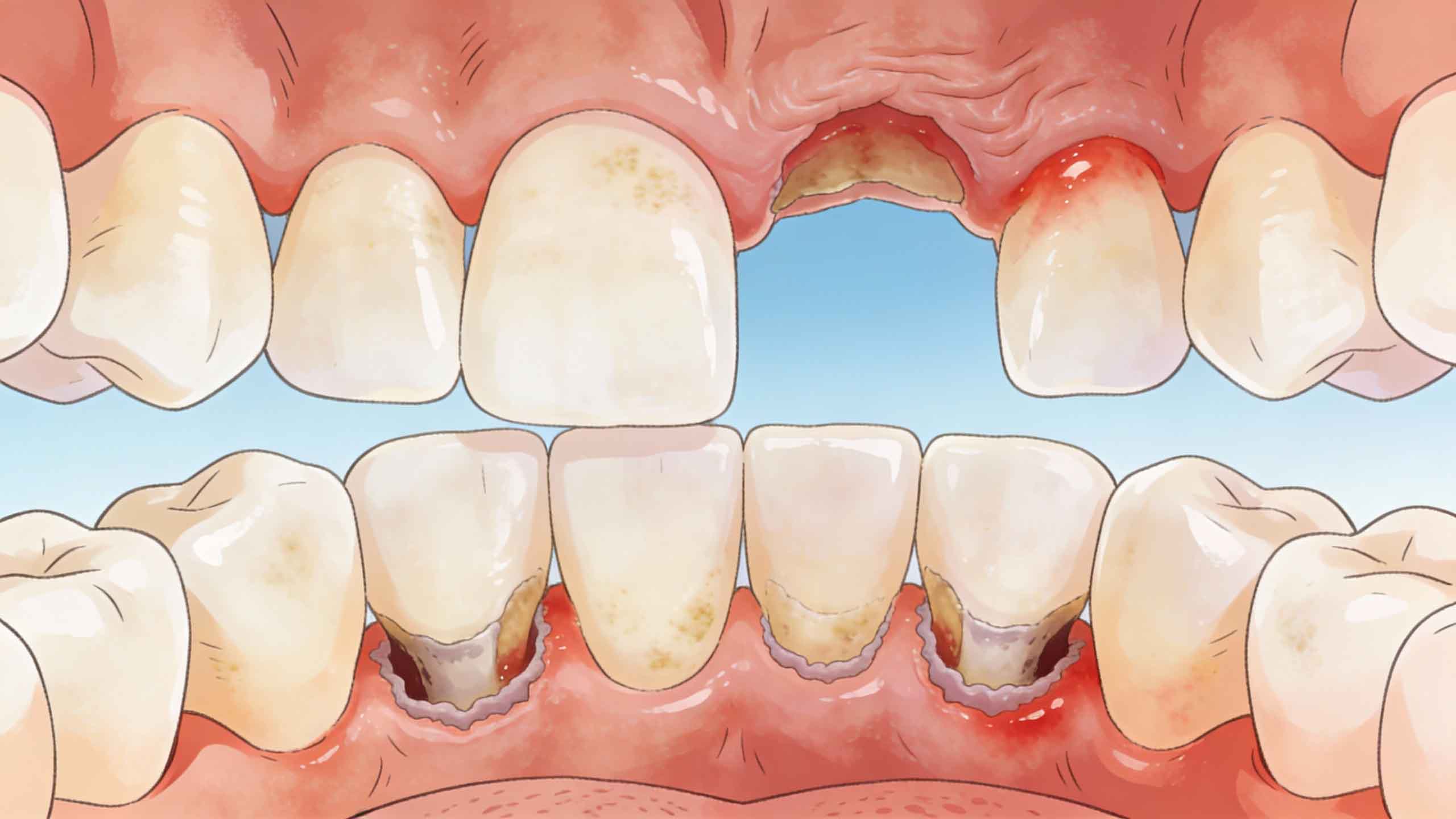 我的牙龈萎缩了，还能长回去吗？