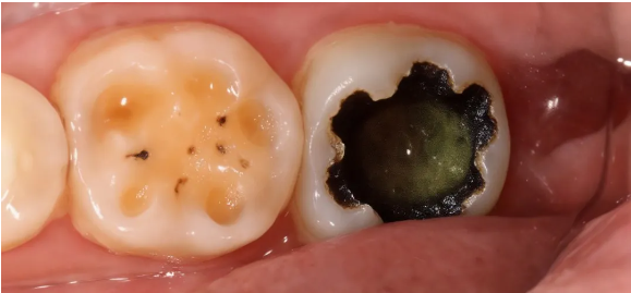 【口腔科普】明明不吃糖，为什么还是蛀牙了？真相全在这里！