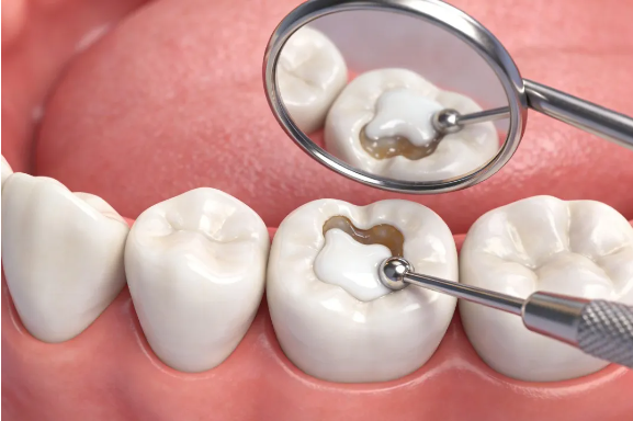 【口腔科普】补牙材料掉了 = 白补？别慌！原因和解决办法一次说透。